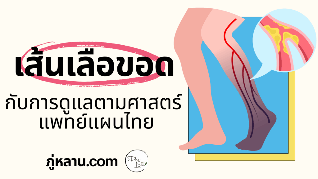 ภู่หลานชวนสังเกตอาการ เส้นเลือดขอด